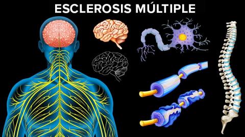 Esclerosis múltiple