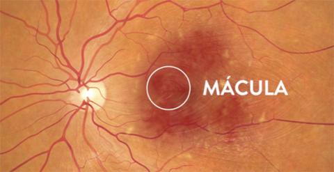 Degeneración macular